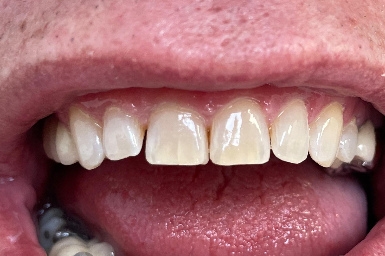 Teinte des dents après blanchiment