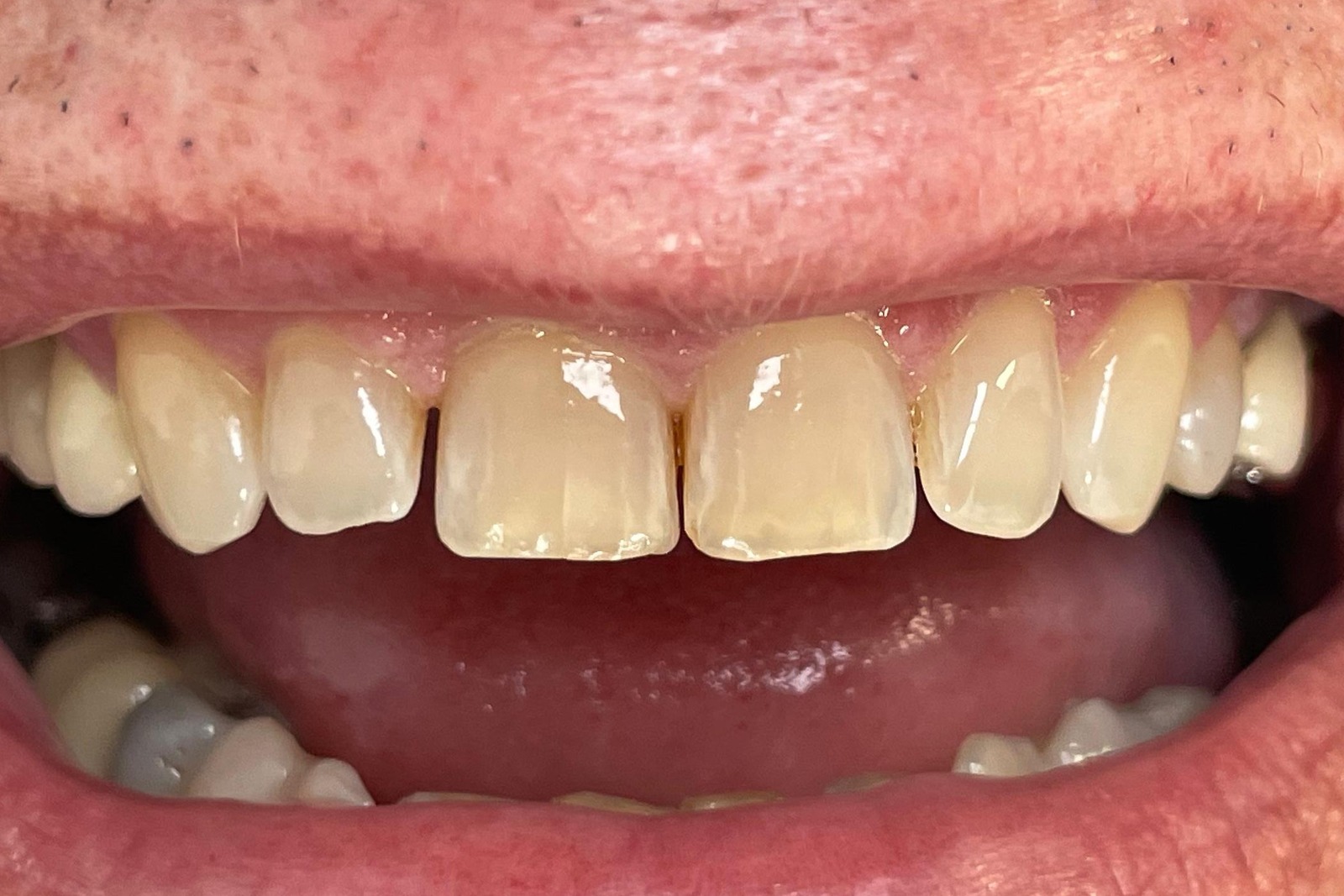 Teinte des dents avant blanchiment