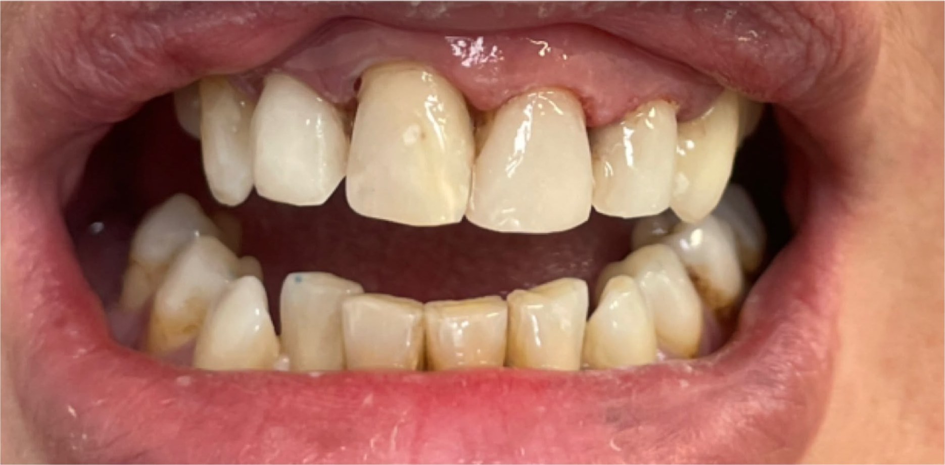 Sourire après la pose de facettes en composite sur les quatre incisives supérieures